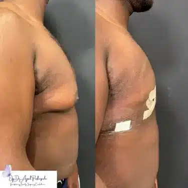 Коррекция гинекомастии