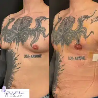 Коррекция гинекомастии