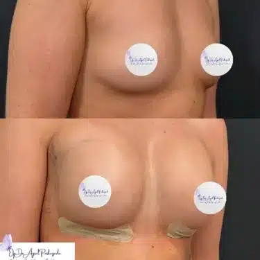 Маммопластика