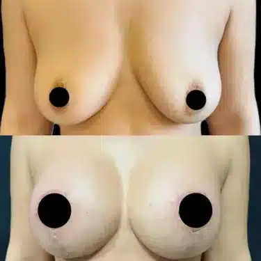 Подтяжка груди