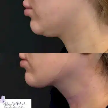 Липосакция подбородка