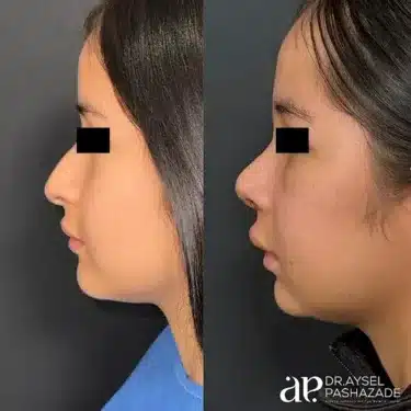 Пластика носа