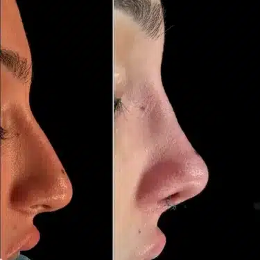 Пластика носа