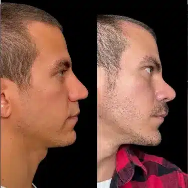 Пластика носа