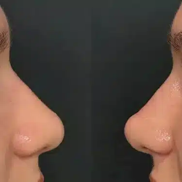 Пластика носа