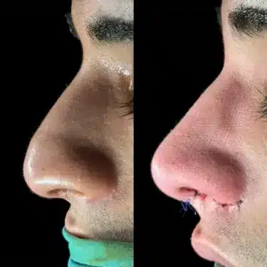 Пластика носа