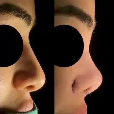 Пластика носа