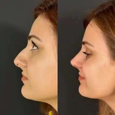 Пластика носа