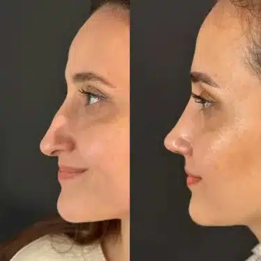 Пластика носа