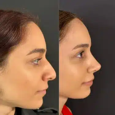 Пластика носа