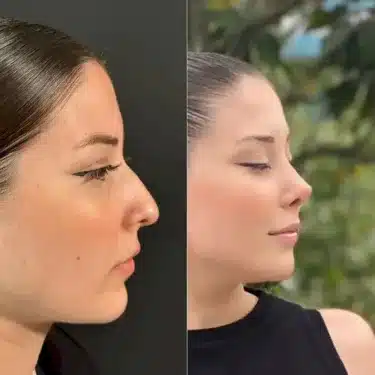 Пластика носа