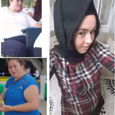 Хирургия похудения