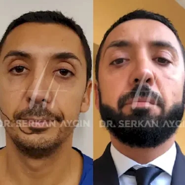 Beard transplantation in Turkey