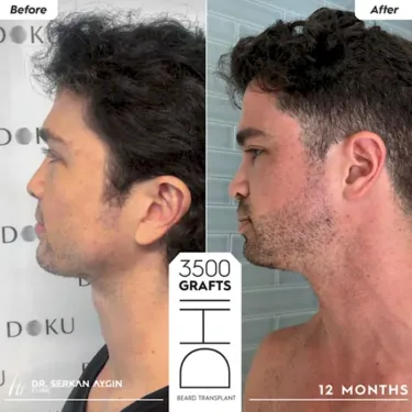 Beard transplantation in Turkey