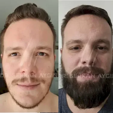 Beard transplantation in Turkey