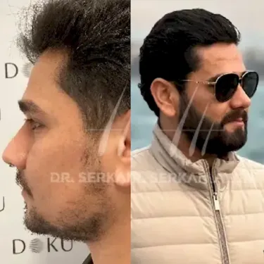 Beard transplantation in Turkey