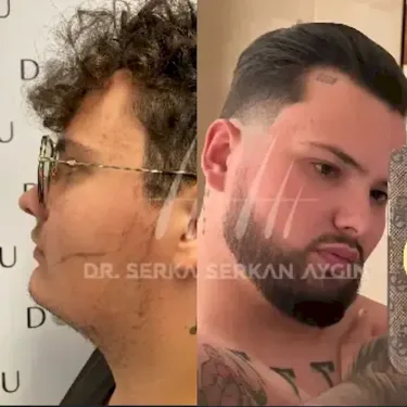 Beard transplantation in Turkey