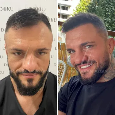DHI hair transplant