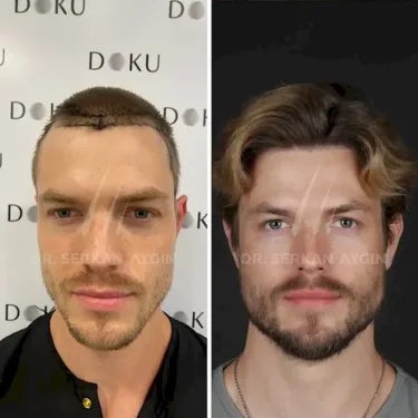 DHI hair transplant