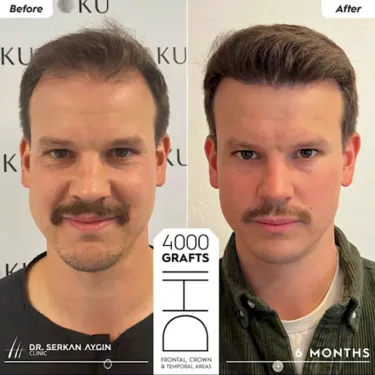 DHI Hair Transplant in Turkey