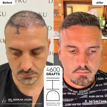 DHI Hair Transplant in Turkey