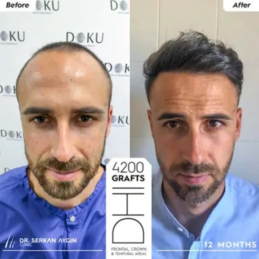 DHI Hair Transplant in Turkey