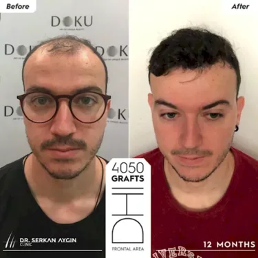 DHI Hair Transplant in Turkey