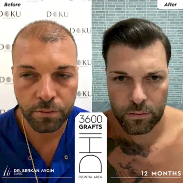 DHI Hair Transplant in Turkey