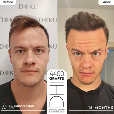 DHI Hair Transplant in Turkey