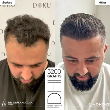 DHI Hair Transplant in Turkey