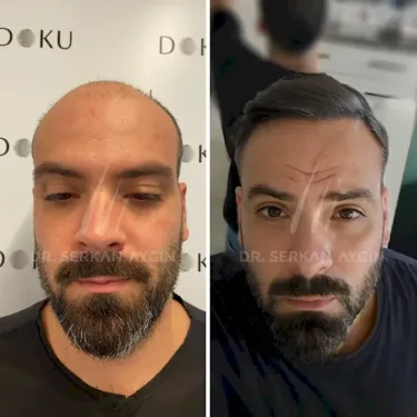 DHI hair transplant