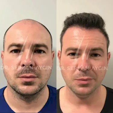 FUE hair transplant