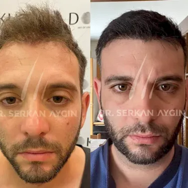 FUE hair transplant