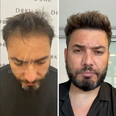 FUE hair transplant
