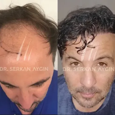 FUE hair transplant