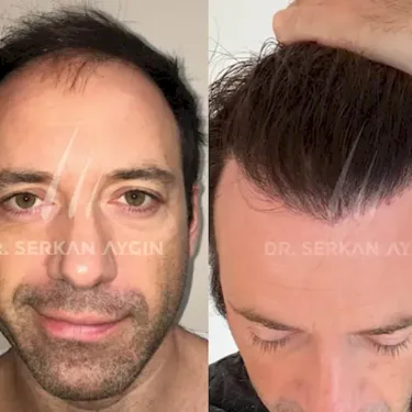 FUE hair transplant