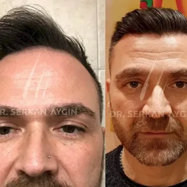 FUE hair transplant