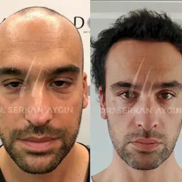 FUE hair transplant