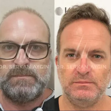 FUE hair transplant