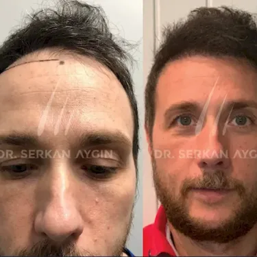 FUE hair transplant