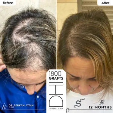 Hair Transplantation for Women