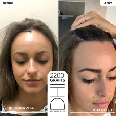 Hair Transplantation for Women