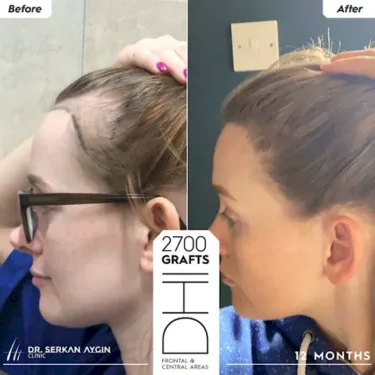 Hair Transplantation for Women