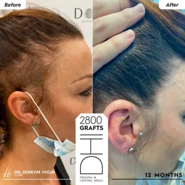 Hair Transplantation for Women