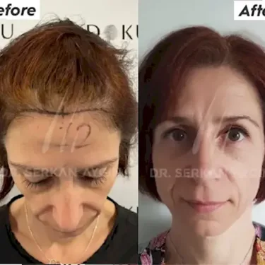 Hair Transplantation for Women