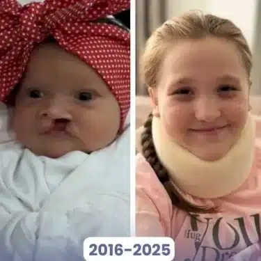 Расщелина губы и мягкого неба