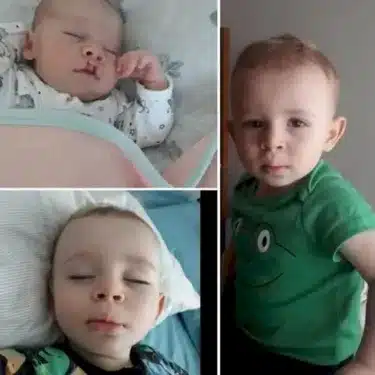 Расщелина губы и мягкого неба