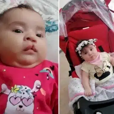 Расщелина губы и мягкого неба