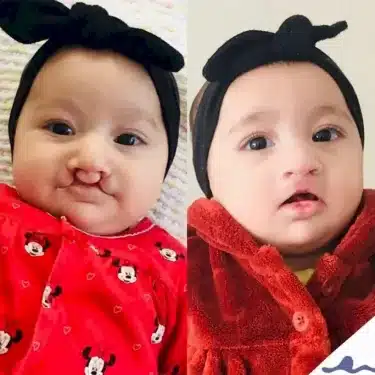 Расщелина губы и мягкого неба