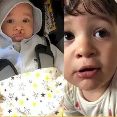 Расщелина губы и мягкого неба